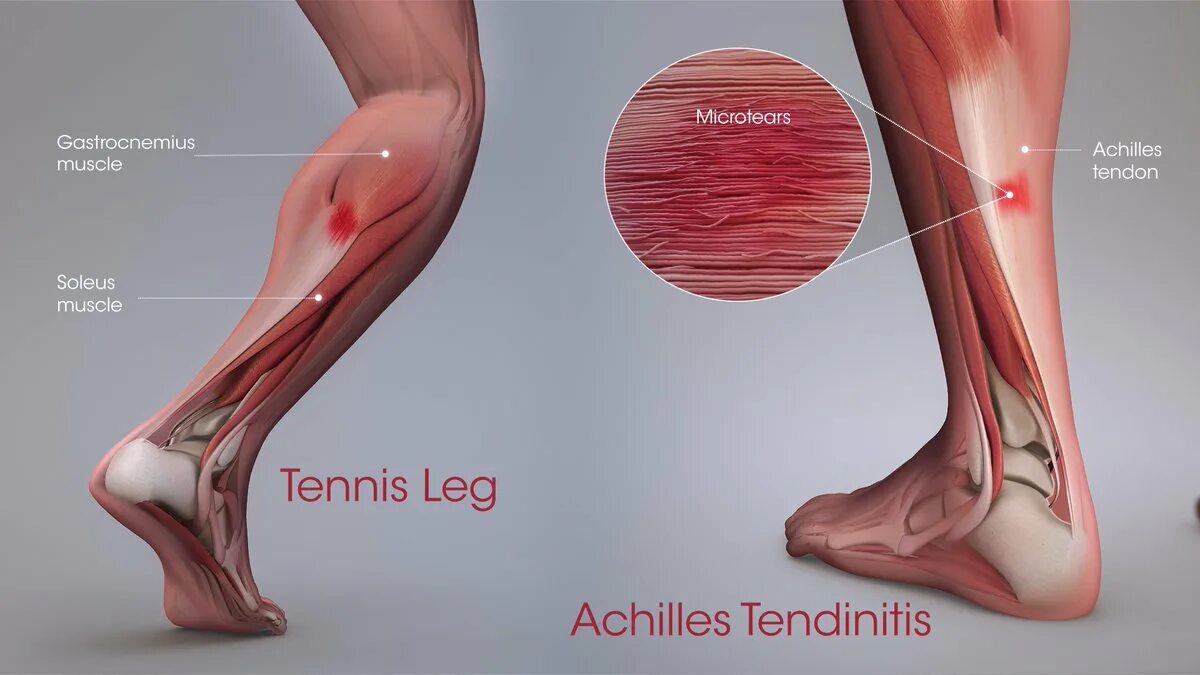 Боль в икрах ног причины у мужчин. Тендинит ахиллова сухожилия. Ахиллово сухожилие бег. Энтезопатия ахиллова сухожилия. Тендиниты ахиллова сухожилия.