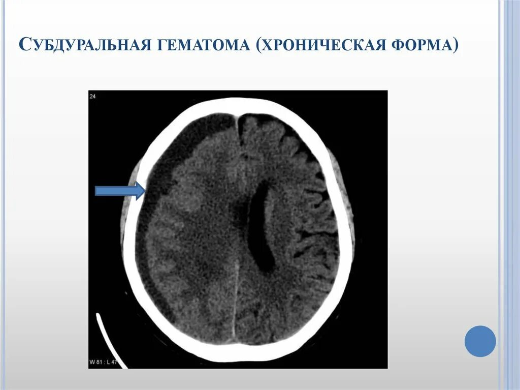 Хроническая субдуральная гематома на кт. Конвекситальная субдуральная гематома. Субдуральная и эпидуральная гематома. Эпи субдуральная гематома кт.