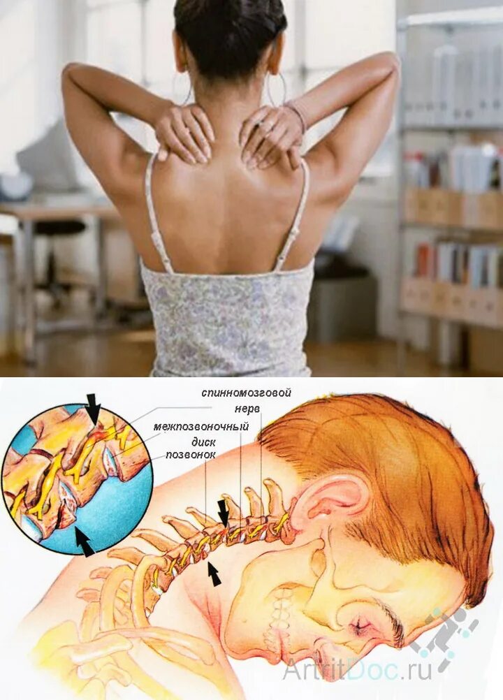 Болеть голова массаж шея. Шейный остеохондроз. Шея при остеохондрозе. Массаж шейного отдела позвоночника. Остеохондроз шейного отдела позвоночника.