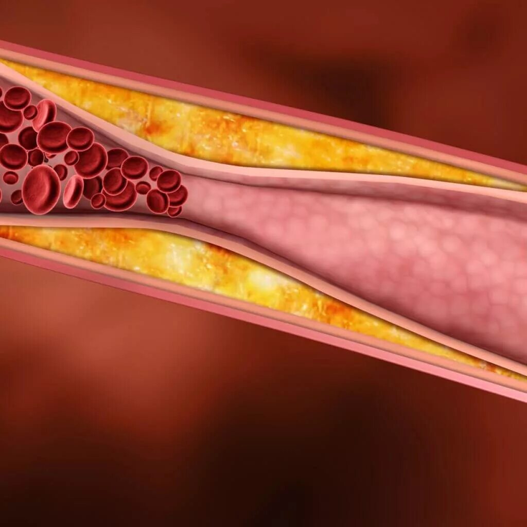 Чем чистить холестериновые бляшки. Смешанная гиперхолестеринемия. Холестерин.