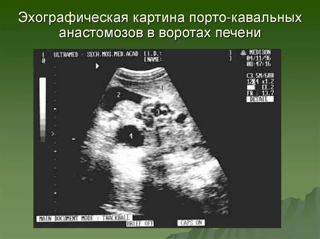 Образование в воротах печени. Портальная гипертензия на УЗИ. Портальная гипертензия у детей на УЗИ. Критерии портальной гипертензии по УЗИ. Пилоростеноз УЗИ картина.