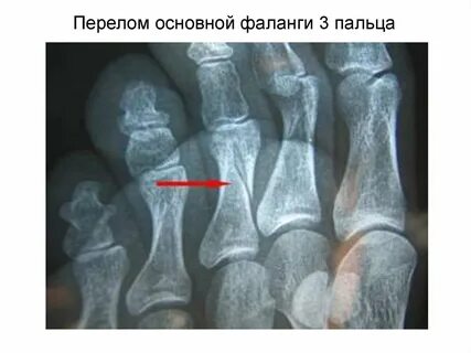 Перелом головки основной фаланги