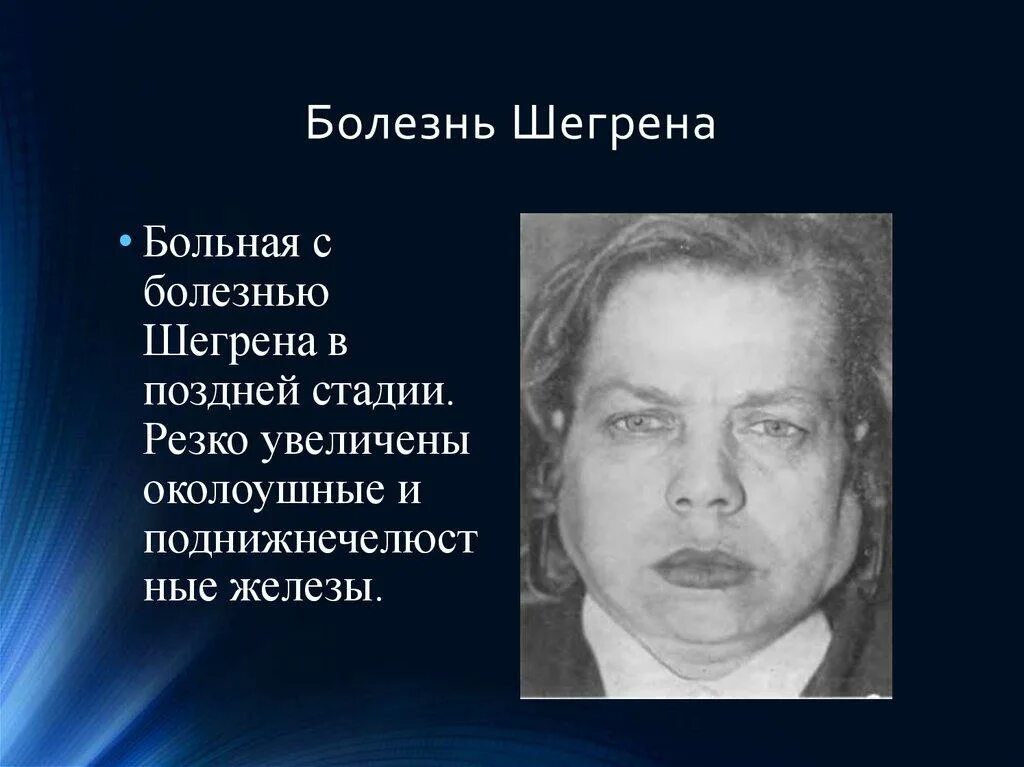 Синдром шегрена простыми. Синдром Шегрена симптомы. Синдром Шегрена клинические проявления. Симптомы синдрома Съегрена.