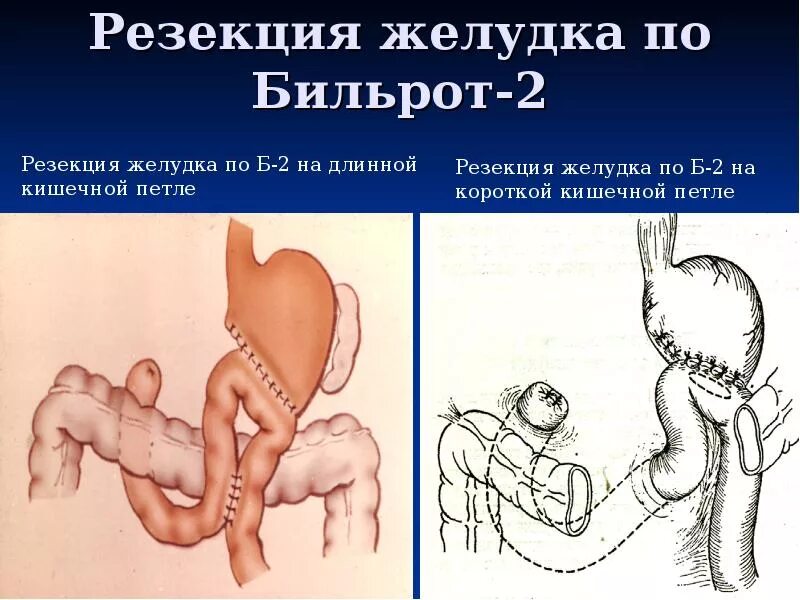 Операция пота. Операция резекция желудка по бильрот 2. модификация бильрот 2 по гофмейстеру. анастомоз по бильрот 1 и бильрот 2. резецированный желудок по бильрот 2.