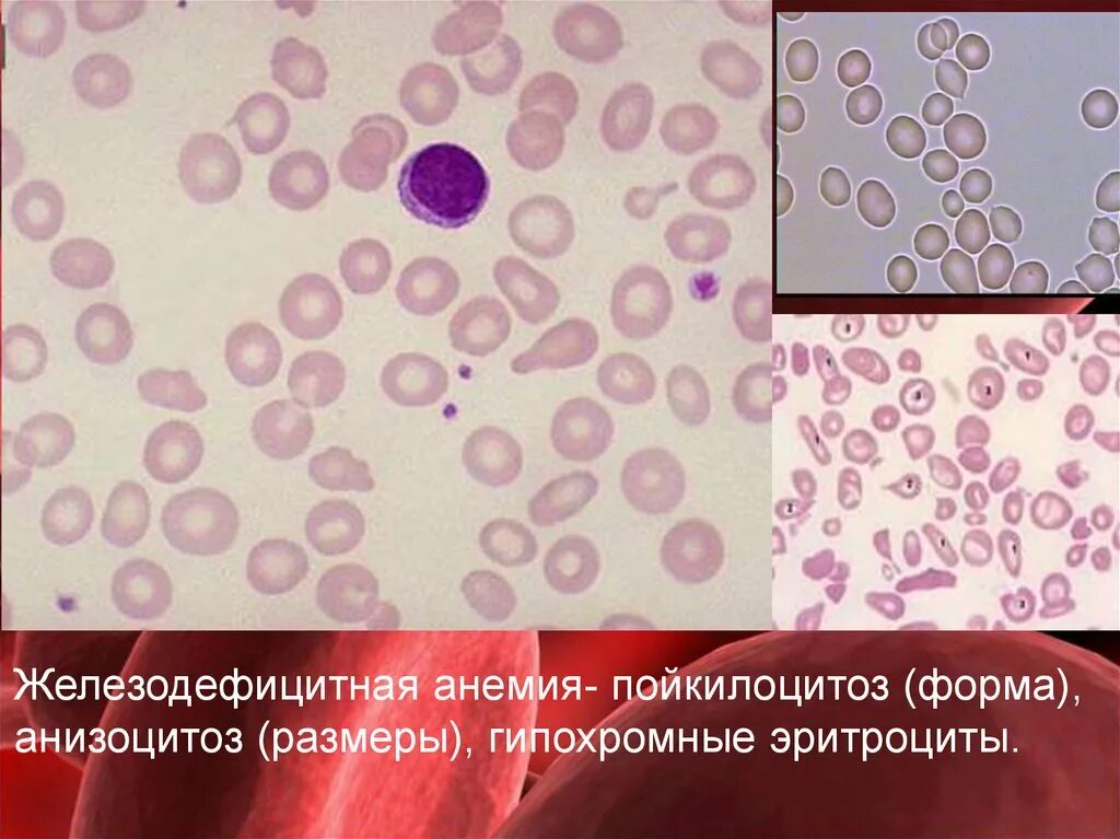 Формы железодефицитной анемии