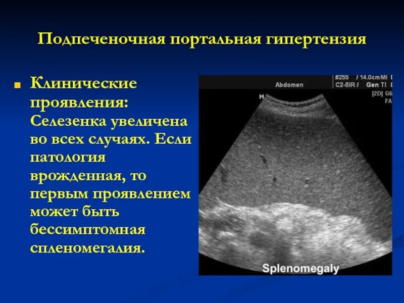 Увеличение селезенки характерно для. Предпеченочная портальная гипертензия клиника. Пресинусоидальная портальная гипертензия. Спленомегалия селезенки УЗИ. Синдром портальной гипертензии УЗИ.