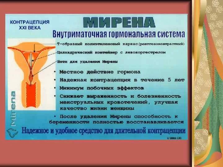 Спираль от беременности минусы. Внутриматочные контрацептивы. Спираль внутриматочная. . Внутриматочная контрацепция минусы. Внутриматочная контрацепция плюсы.