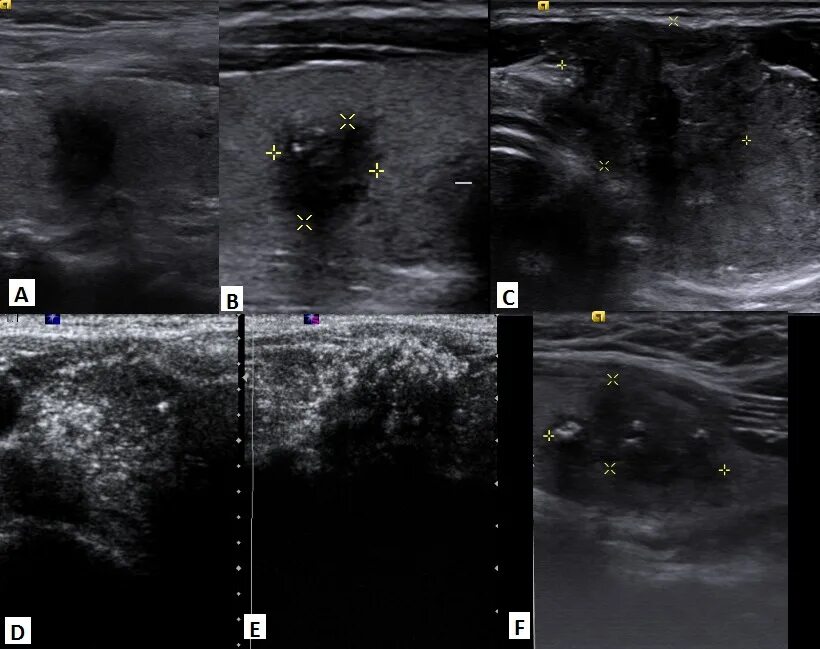 Гиперэхогенный узел в щитовидной железе УЗИ. Узел в щитовидной железе на УЗИ. Щитовидная железа УЗИ ti-rads. УЗИ щитовидной железы образование ti_rads 3,4.