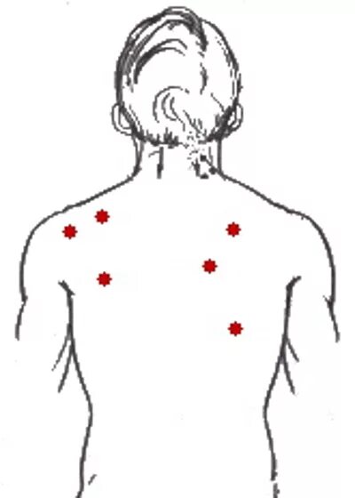 Точечный массаж спины. Триггерные точки при невралгии. Массаж триггерных точек. Болевые точки мышц шеи. Точечный массаж позвоночника.