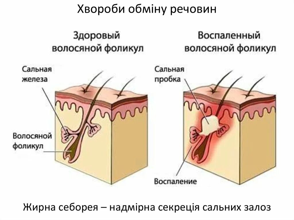 4 функция сальных желез. Фолликулит – воспаление волосяных фолликул.. Волосяной фолликул и сальная железа. Сальные железы кожи головы.