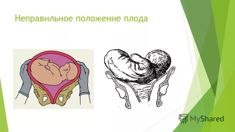 неправильное расположения. неправильное расположения. причины искривления осанки. правильная осанка сидя. сколиоз у детей школьного возраста причины и лечение.