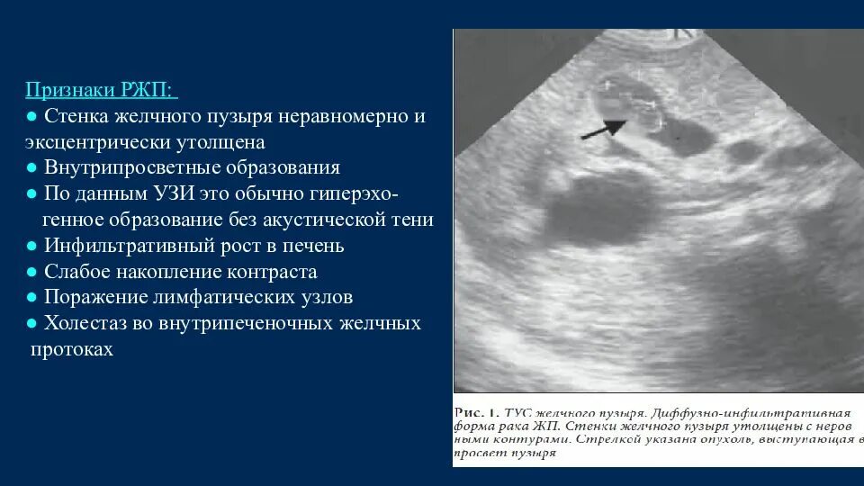 Образование без акустической тени. Опухоль протоков желчного пузыря на УЗИ. Злокачественные новообразования желчного пузыря. Объемное образование желчного пузыря. Карцинома желчного пузыря УЗИ.