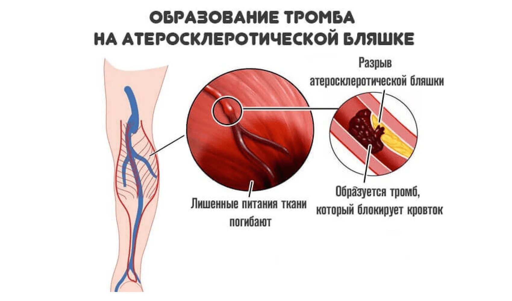 Образование тромбов в артериях. Атеросклеротическая бляшка и тромб. Тромб определение