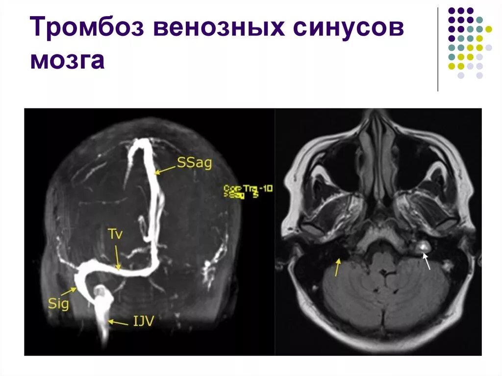 Тромбоз поперечного синуса кт. Тромбоз поперечного синуса мрт. Тромбоз синусов головного мозга кт. Тромбоз сагиттального синуса на кт. Мрт тромбоз