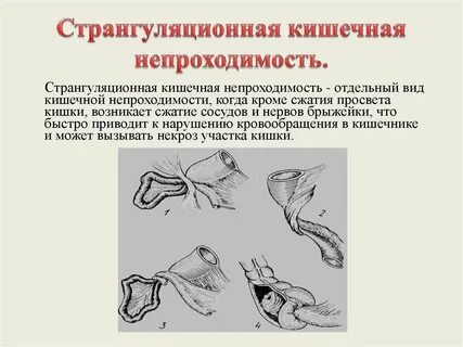 Острая непроходимость кишечника