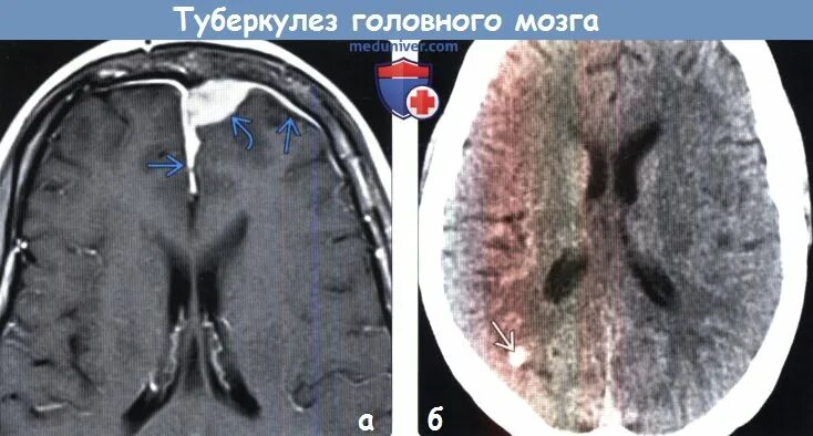 Мозговой туберкулез. Туберкулема головного мозга на кт. Туберкулома головного мозга кт. Туберкулома головного мозга мрт. Туберкулезный абсцесс мозга кт.