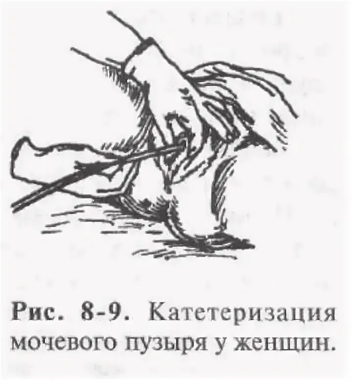 Удалить катетер. Постановка мочевого катетера женщине алгоритм. катетеризация мочевого пузыря у женщин схема. катетеризация мочевого пузыря женщины проводится катетером. катетеризация мочевого пузыря рисунок.