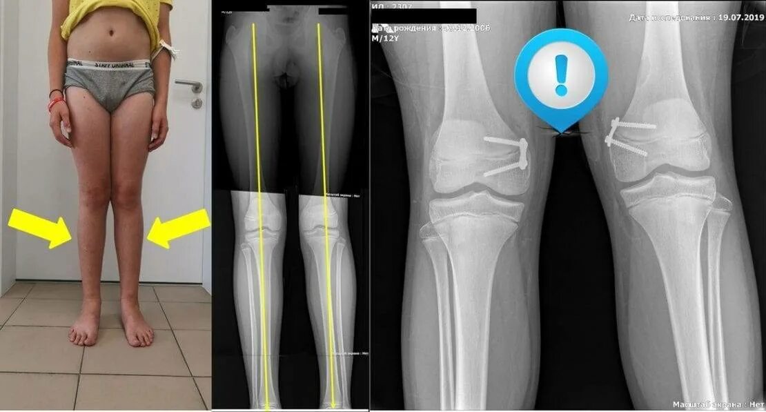Деформация коленного сустава у детей. Вальгусная деформация коленных суставов. Варусная деформация коленных суставов (Genu Varum) —. Варусная деформация сустава рентген.