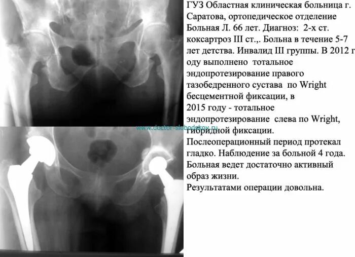 Артроз положена ли инвалидность. Артроз тазобедренного сустава 3 степени положена ли инвалидность. коксартроз после эндопротезирования диагноз. коксартроз тазобедренного сустава инвалидность. инвалидность с тазобедренным суставом.