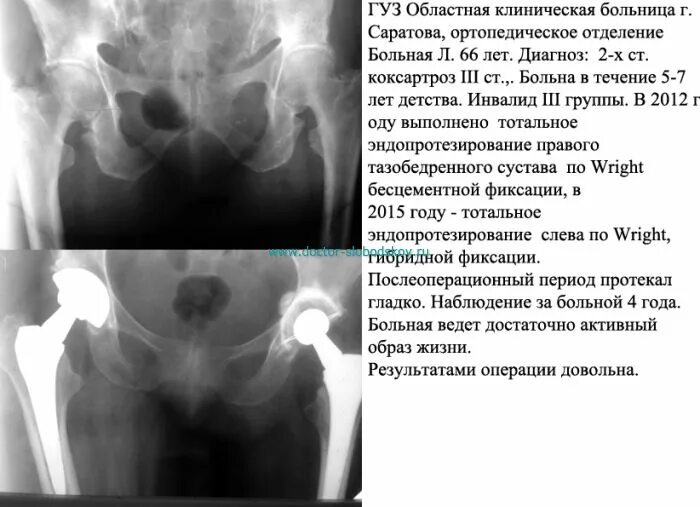 Инвалидность после эндопротезирования. Артроз тазобедренного сустава 3 степени положена ли инвалидность. Коксартроз 3 степени тазобедренного сустава сняли инвалидность. Коксартроз эндопротезирование. Коксартроз после эндопротезирования диагноз.