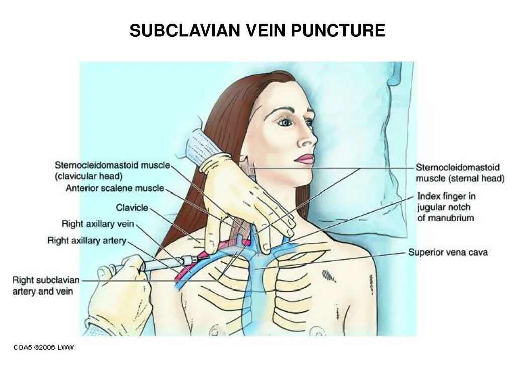 Асимметрия яремных. Внутренняя яремная вена внутричерепные притоки. Внутренняя яремная вена анатомия кт. Луковица внутренняя яремная вена анатомия. Тромбоз синуса ангиография.