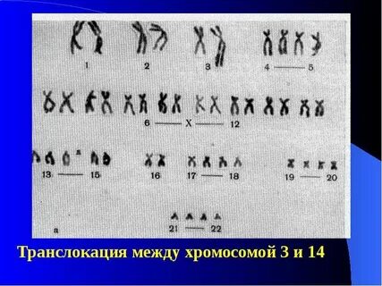 Транслокация 15 хромосомы на 15