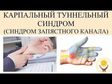 Карпальный синдром лечение