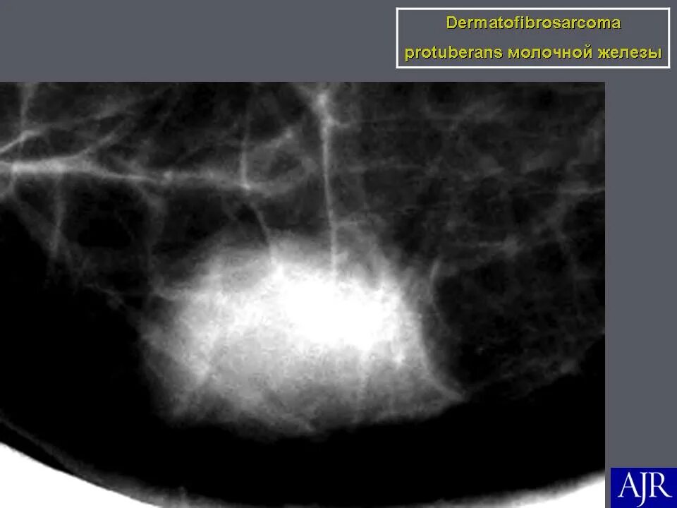 Рак молочной железы метастазы в легких. Метастаз карциномы молочной железы. Метастазы молочной железы на УЗИ. Дерматофибросаркома Протуберанс. Метастазы в молочную железу.