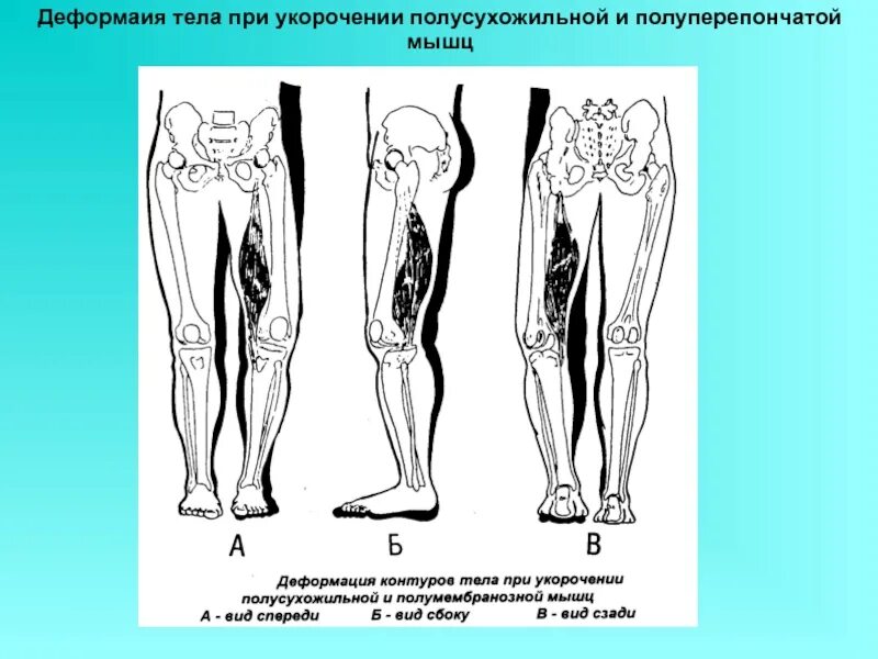 Укорочение трубчатых. Укорочение нижней конечности. Укорочение нижних конечностей рисунок. Укорочение полусухожильной мышцы бедра.