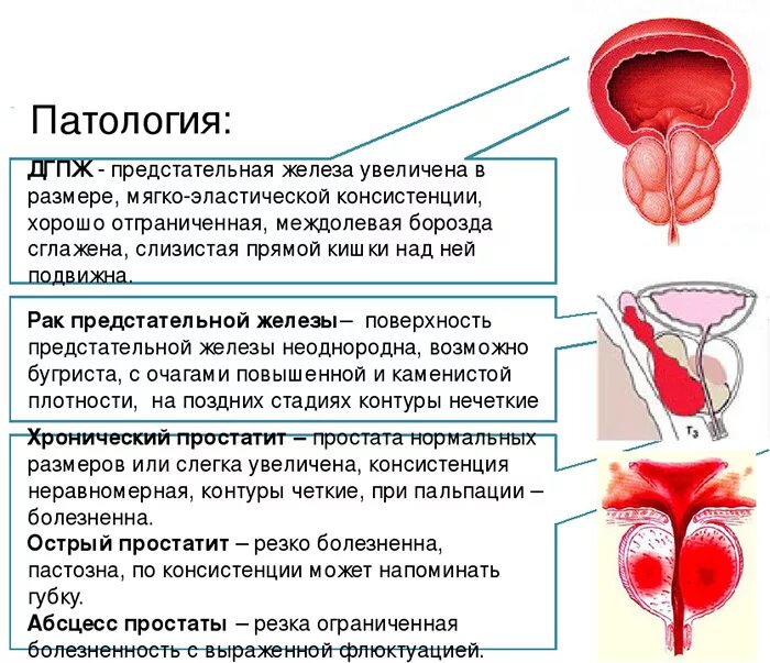 Зно предстательная железа. Зно предстательная железа. Зно предстательная железа. Зно предстательная железа. Профилактика простаты.