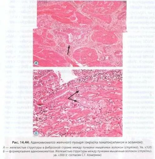 аденоматоз желчного пузыря на узи. аденоматоз желчного пузыря мрт. фокальный аденомиоматоз желчного пузыря. аденомиоз желчного пузыря кт. аденомиоматоз желчного пузыря что это такое.