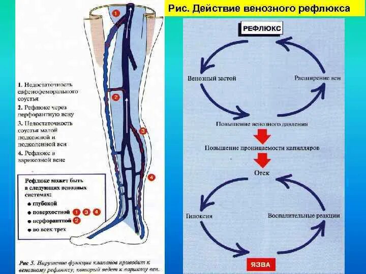 Рефлюкс нижних конечностей