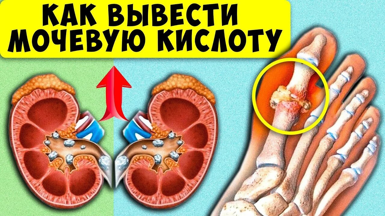 Выводим мочевую кислоту из организма народными. 10 Продуктов растворят Кристаллы мочевой кислоты. Кристаллы мочевой кислоты в почках.