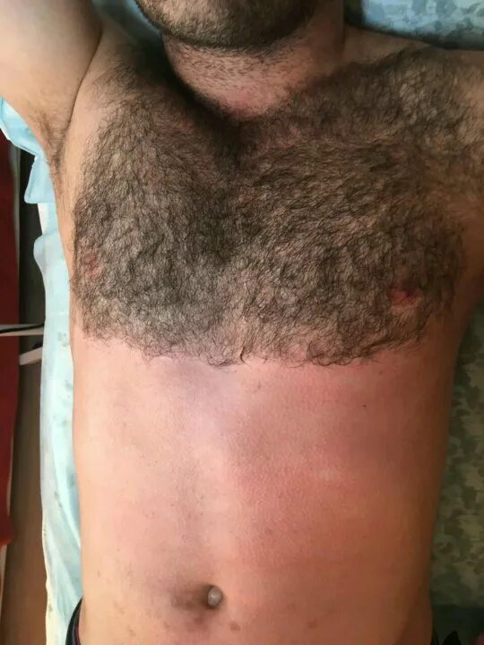 эпиляция бикини мужчинам. мужская депиляция шугаринг. мужская депиляция паховой зоны. мужская эпиляция до и после. мужская депиляция.