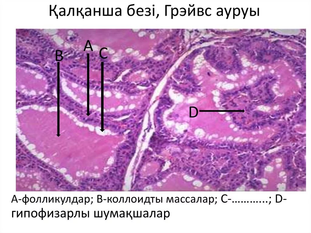 Фолликул щитовидной железы. Коллоидный фолликул щитовидной железы что это такое. Что такое коллоидные фолликулы в щитовидной железе. Коллоидные массы в щитовидной железе гистология.