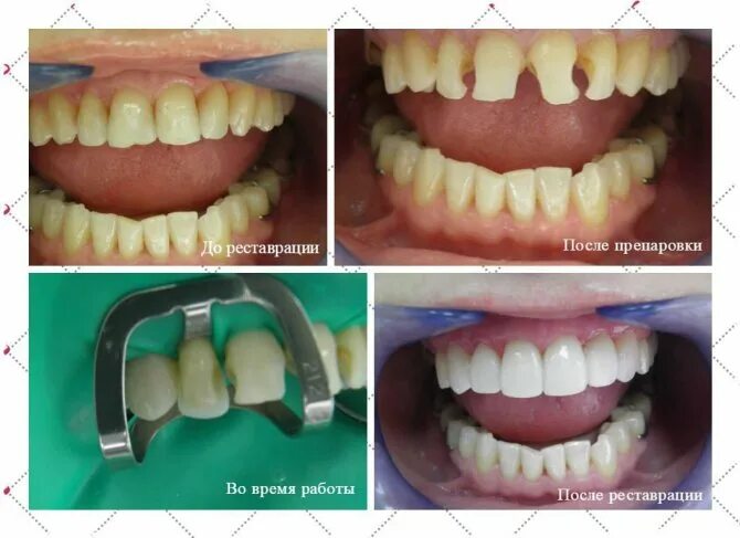 наращивание зубов композитными материалами. наращивание зубов до и после. можно ли увеличить зуб. наращивание зубов клыки. орбакайте виниры.