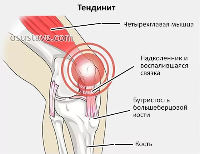 Тендинит коленных связок. Тендинит бурсит коленного сустава. Супрапателлярный бурсит коленного сустава что такое. Инфрапателлярный бурсит коленного сустава. Тендинит подколенного сухожилия.