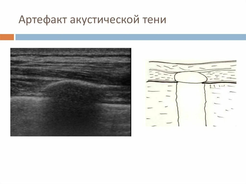 Образование без акустической тени. Артефакты УЗИ дистальная акустическая тень. Артефакт акустической тени. Эффект акустической тени. Артефакт акустической тени возникает дистальнее:.