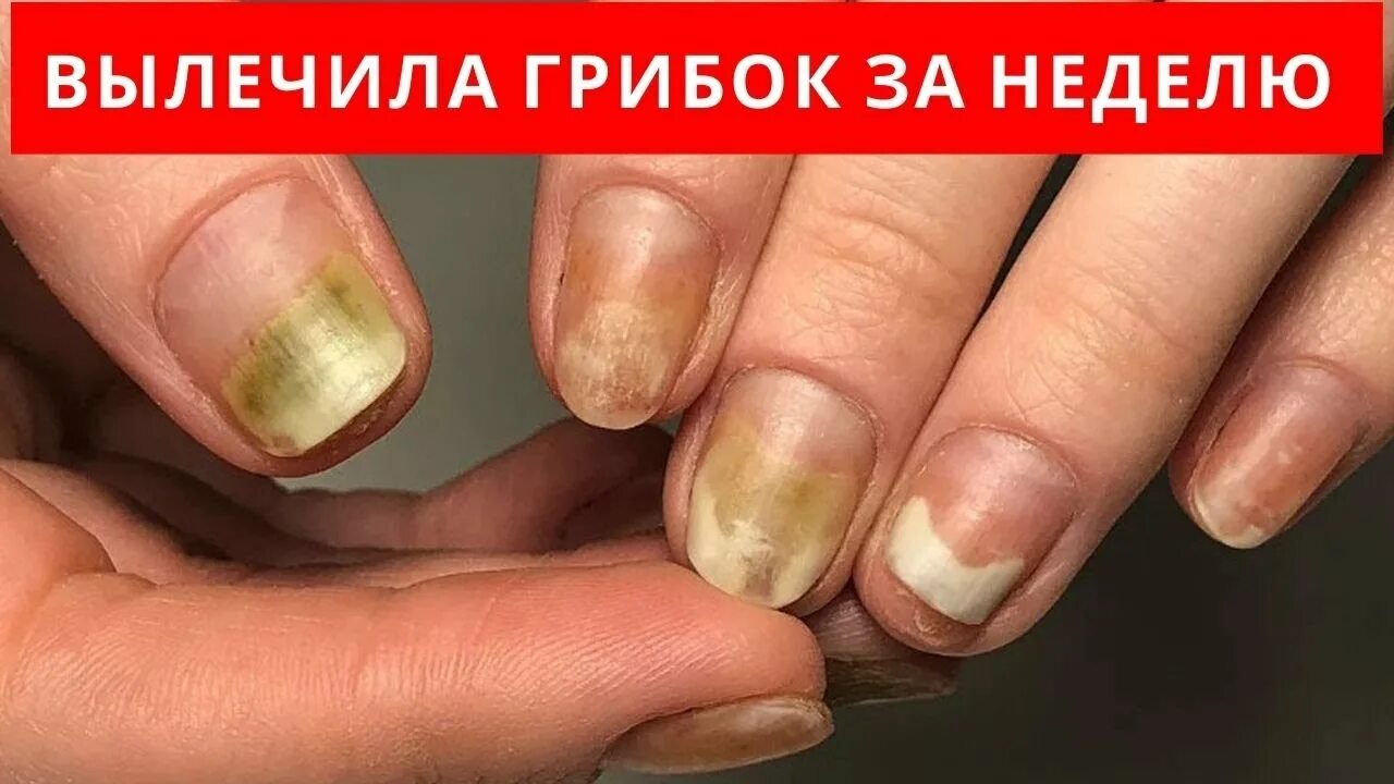 Эффективное лечение грибка ногтей рук