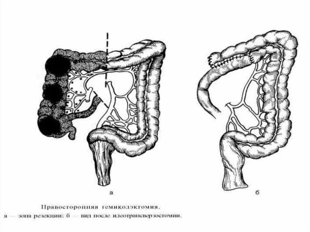 Симптомы операция кишечнике. Правосторонняя гемиколэктомия ободочной кишки. Левосторонняя гемиколэктомия анастомоз. Операция левосторонняя гемиколэктомия. Правосторонняя гемиколэктомия схема операции.