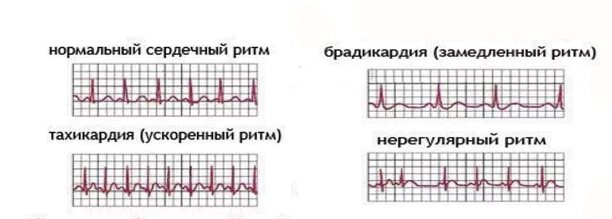ЭКГ синусовая тахикардия брадикардия аритмия. Нормальный сердечный ритм на ЭКГ. Электрокардиограмма показатели синусовый ритм. Синусовая брадикардия на ЭКГ.