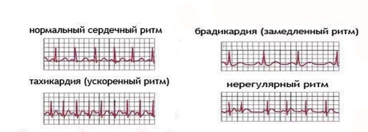 Учащенное сердцебиение при нагрузках. ЭКГ синусовая тахикардия брадикардия аритмия. Нормальный сердечный ритм на ЭКГ. Электрокардиограмма показатели синусовый ритм. Синусовая брадикардия на ЭКГ.