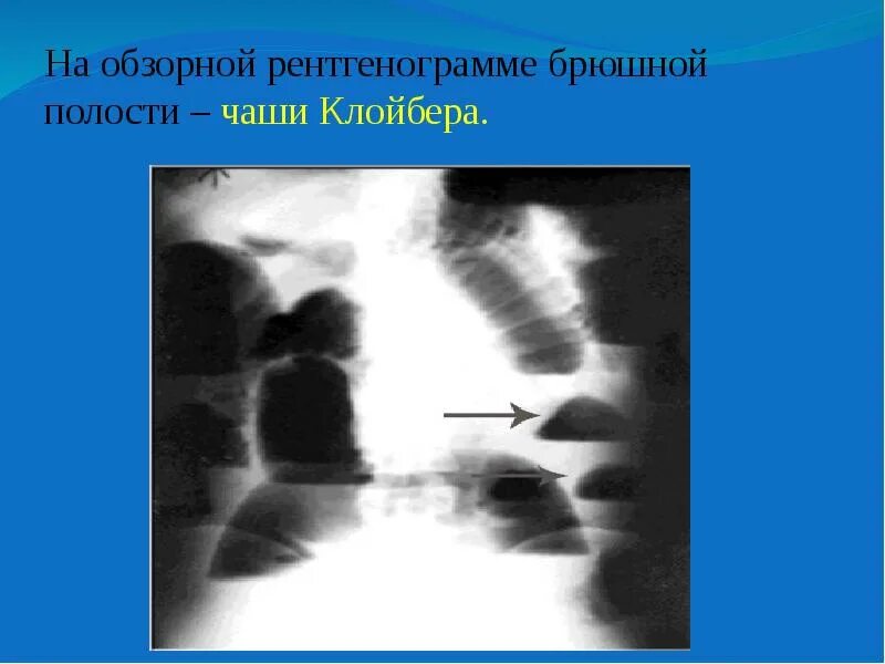 Симптом чаши. Кишечная непроходимость чаши клойбера. обзорная рентгенография брюшной полости чаши клойбера. рентген брюшной полости чаши клойбера. рентген чаши клойбера заключение.