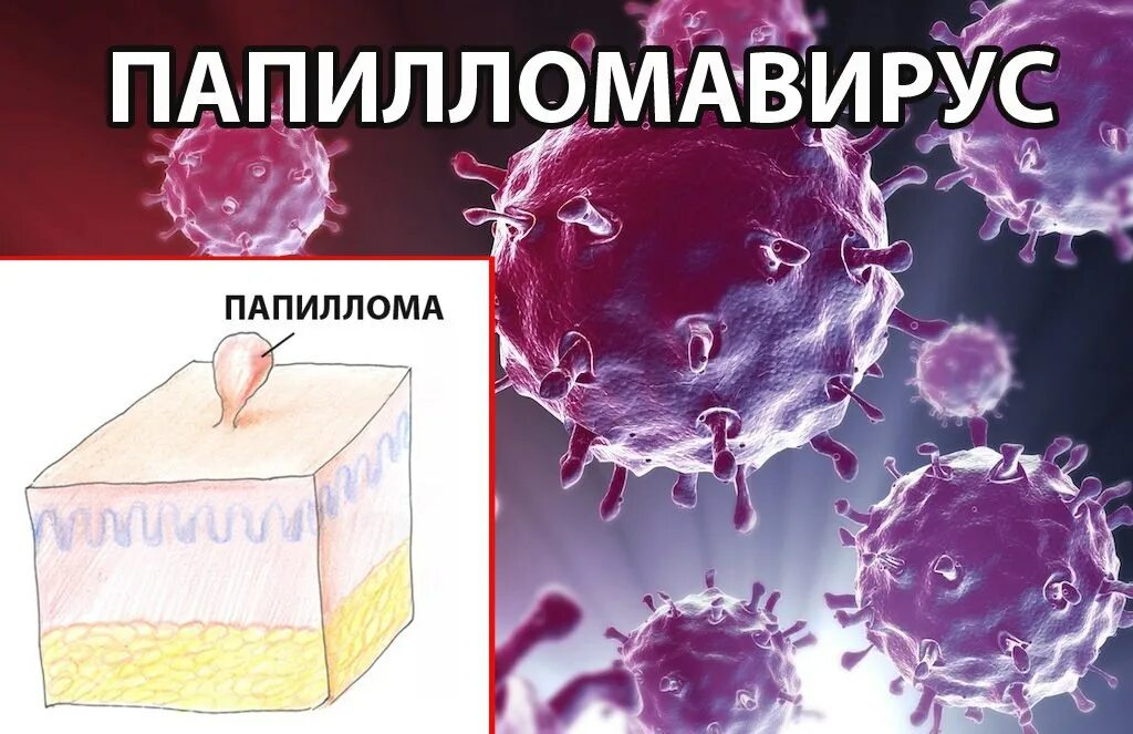 Как вылечить вирус папилломы человека. Вирус папилломы человека картина.