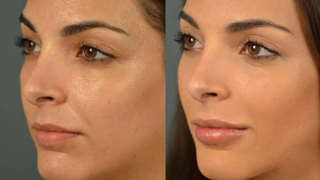 коррекция скул филлерами. контурная пластика ску. пластика скул радиесс. коррекция скул филлерами до и после. коррекция лица филлерами до и после.