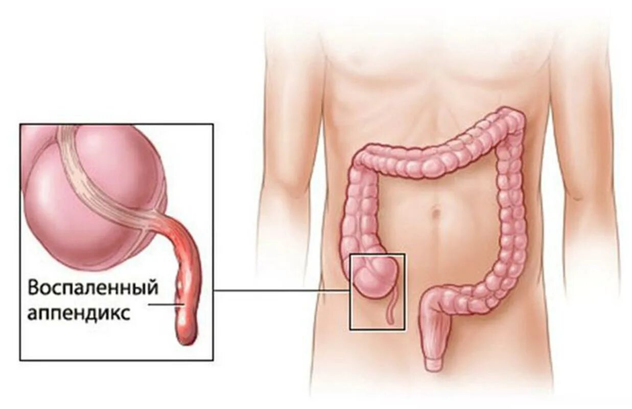 Боль в аппендиксе. Червеобразный отросток аппендикс. Где находится аппендицит. Аппендикс позади слепой кишки. Воспаление аппендикса симптомы.