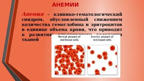 Анемия примеры