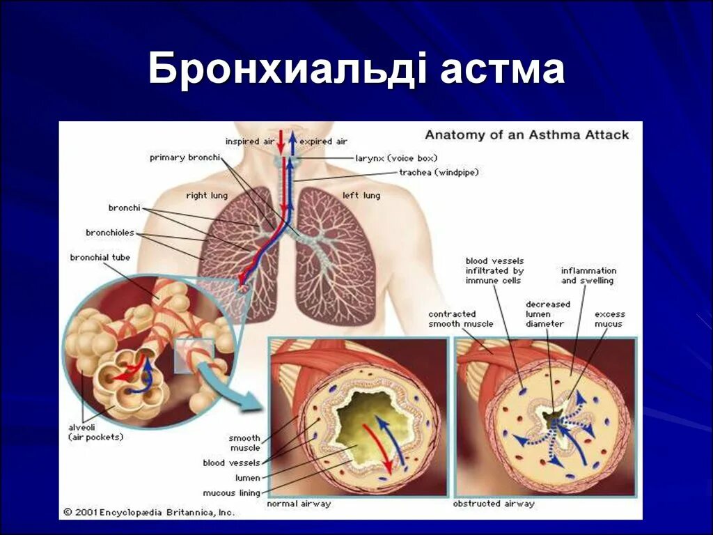 Название врача по легким. Астма. Бронхиальная астма. Бронхи при бронхиальной астме.