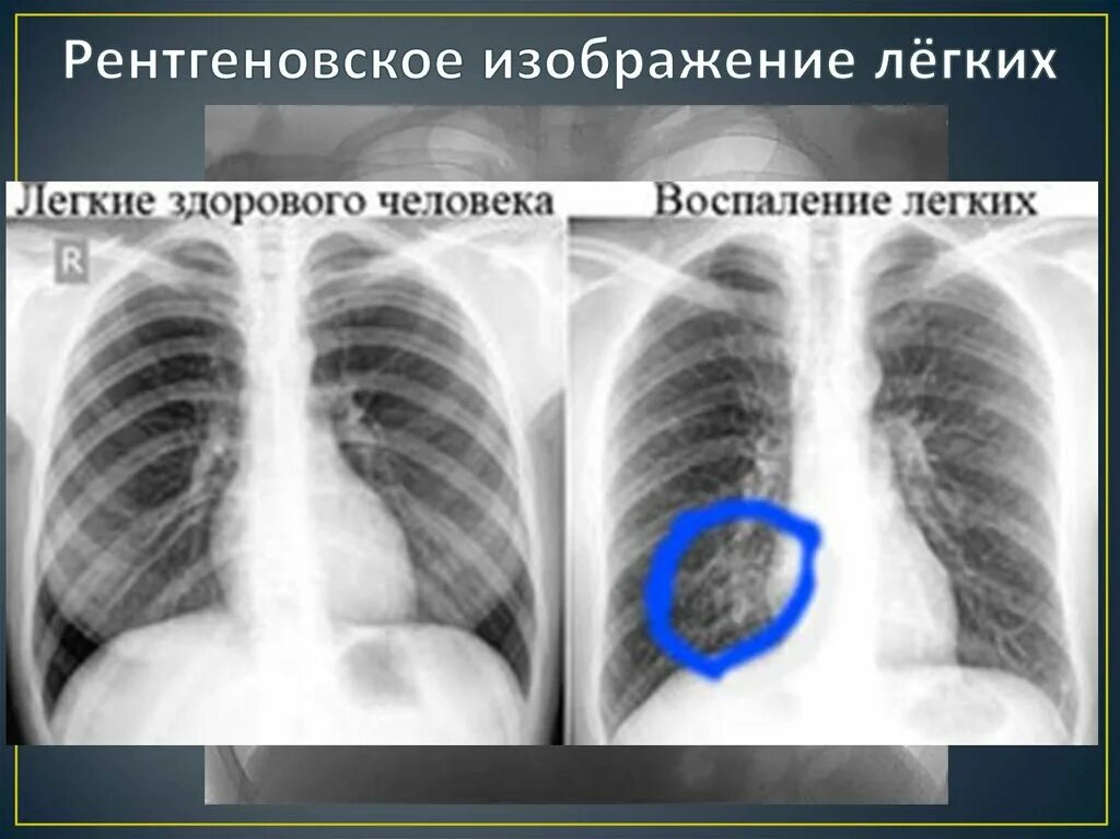 Здоровые легкие и пневмония на рентгене. Легкие человека с пневмонией рентген. Флюорограмма пневмония. Воспаление легких на флюорографии. Какие легкие в норме