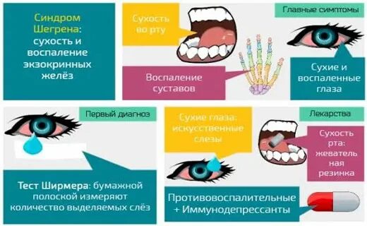 Синдром шегрена простыми. Болезнь Шегрена симптомы. Синдром Шегрена симптомы. Симптомы синдрома Съегрена.